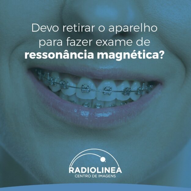 aparelho-ortodontico Aparelho Ortodôntico