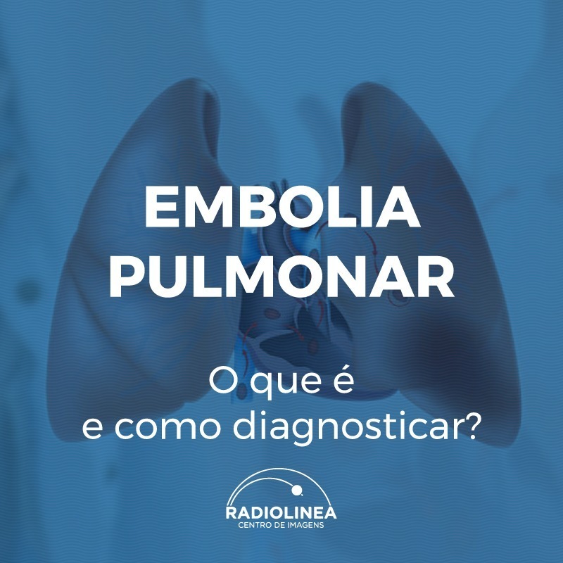 Embolia pulmonar