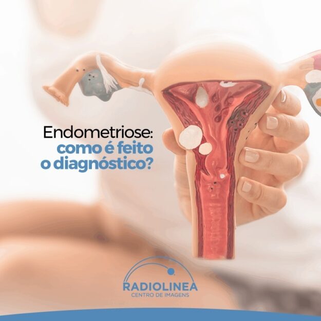 Endometriose-Radiolinea Endometriose Radiolinea