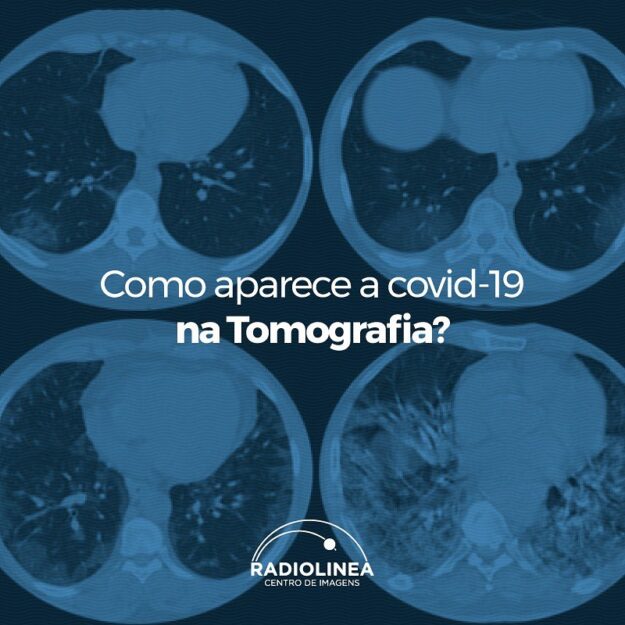 covid-19-radiolinea-tomografia covid-19 tomografia Radiolinea