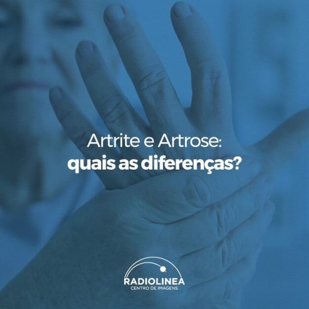 artrite-artrose-radiolinea Artrite e Artrose diferenças Radiolinea Imagens