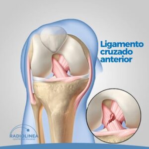 Lesões lesão ligamento cruzado anterior radiolinea